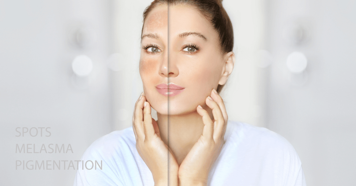 5 bước đơn giản đối phó với vùng da bị sạm đen