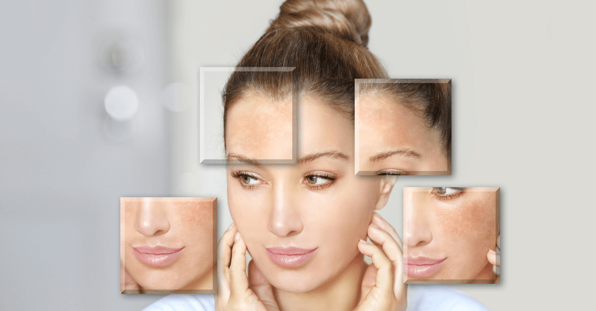 5 Mẹo Hiệu Quả Giúp Điều Trị Da Bị Sạm Màu