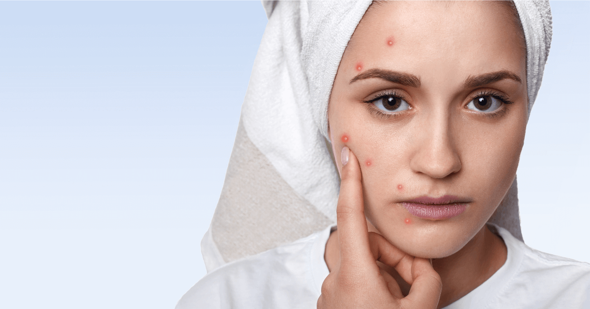 5 Mẹo Hiệu Quả Giúp Điều Trị Da Bị Sạm Màu