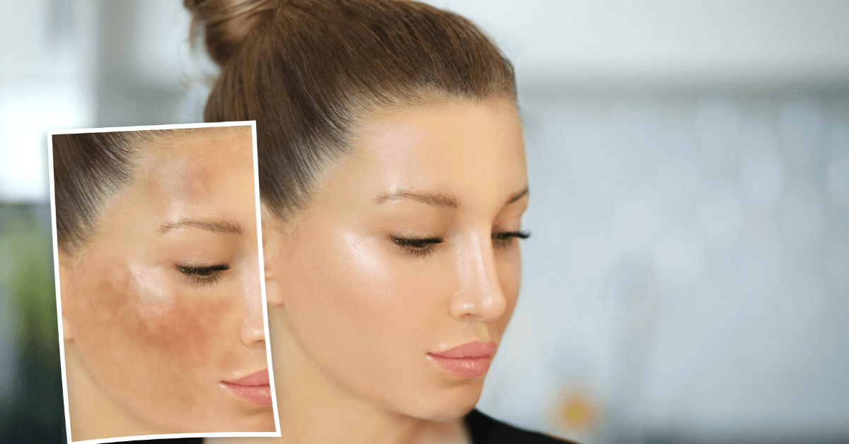 Hướng dẫn đầy đủ để điều trị sạm nám da