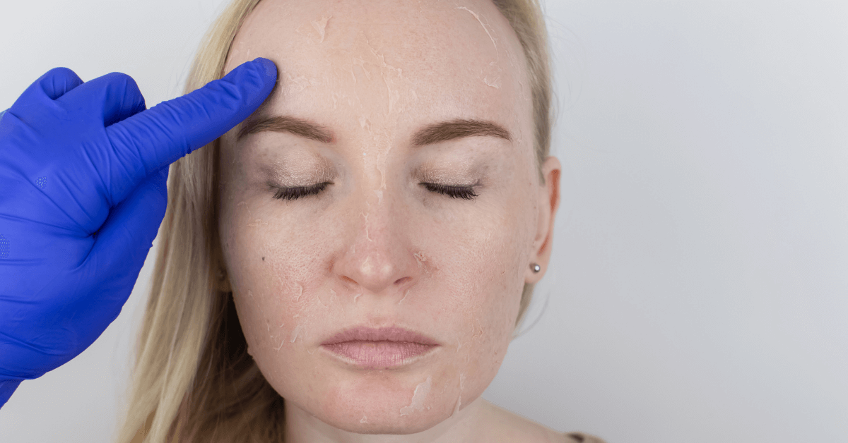 Trị Nám Bằng Laser Có Hết Không? Giải Đáp Từ Chuyên Gia