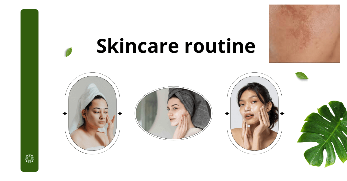 Trị nám bằng laser có tốt không? Khám phá bí mật!