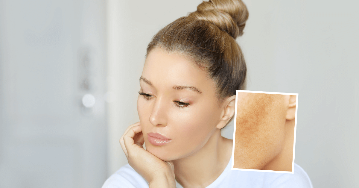 Trị nám bằng laser có tốt không? Khám phá bí mật!