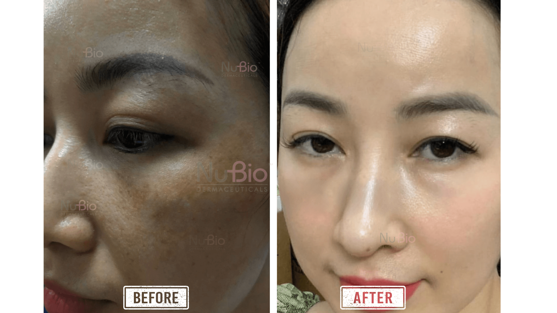 Khách hàng điều trị nám da thành công
