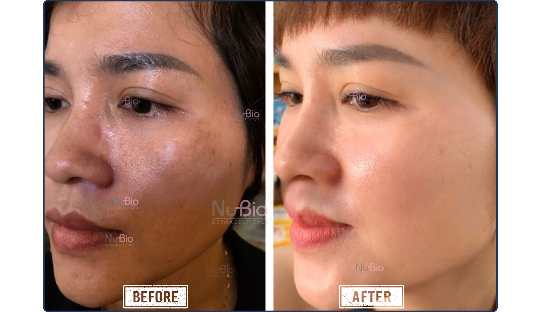 Khách hàng điều trị nám da thành công