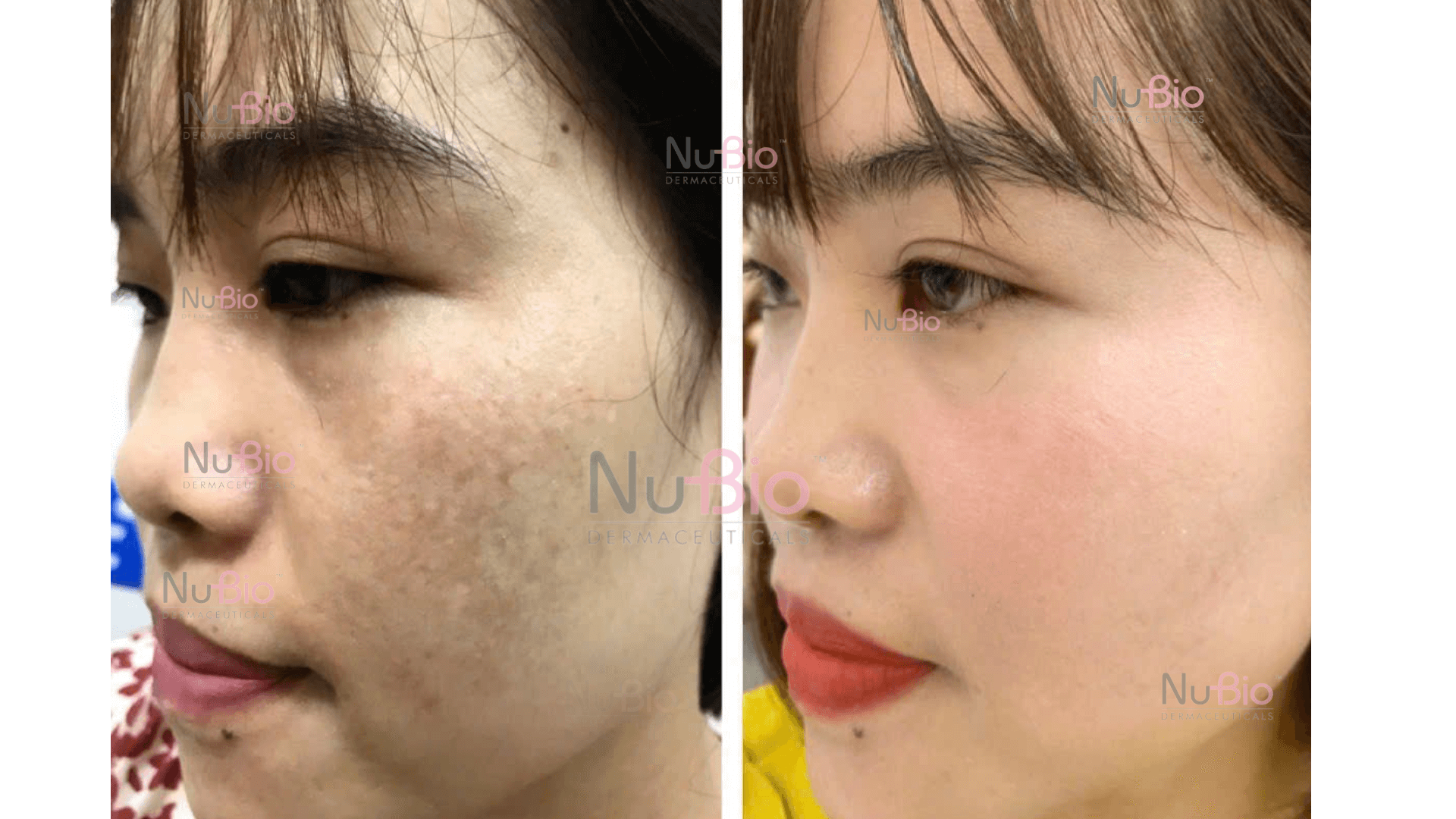 Khách hàng điều trị nám da thành công