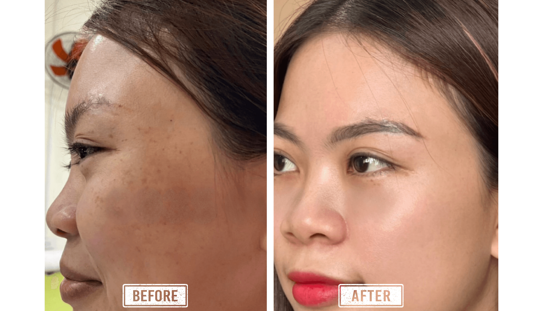 Khách hàng điều trị nám thành công