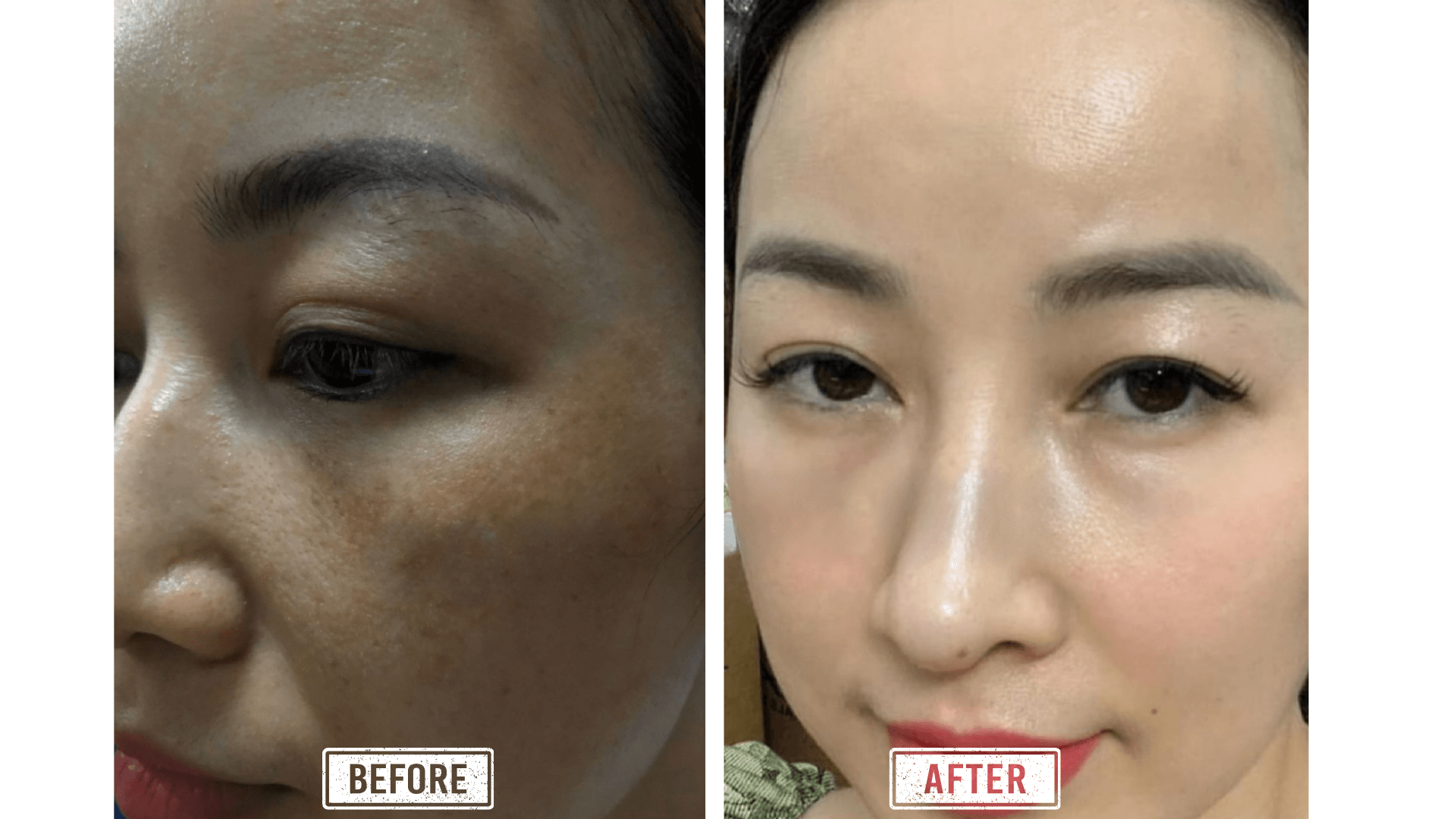 Khách hàng điều trị nám thành công