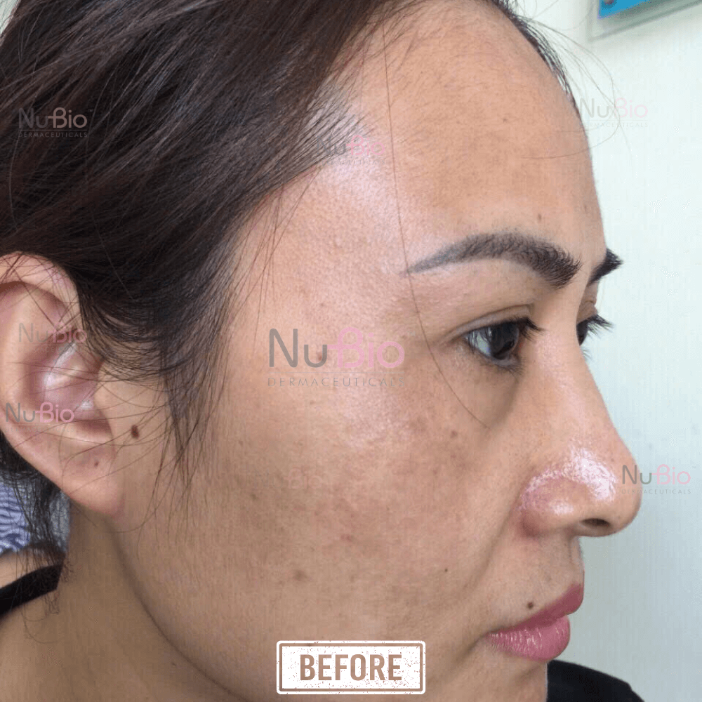 Dược sĩ Hà Phạm điều trị nám da thành công